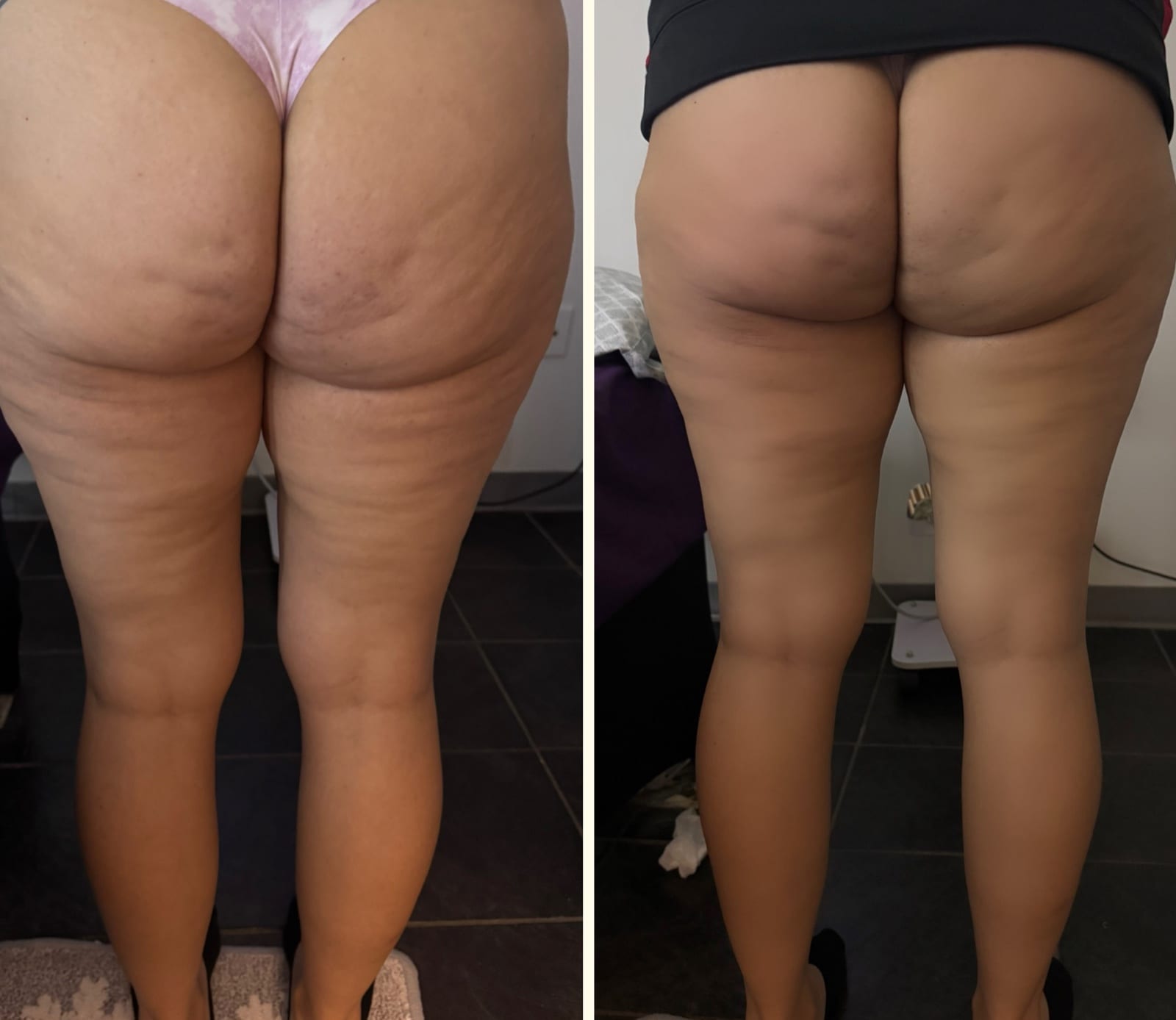 Body sculpting result 1 of 8, a real before and after from a Bossa treatment series.