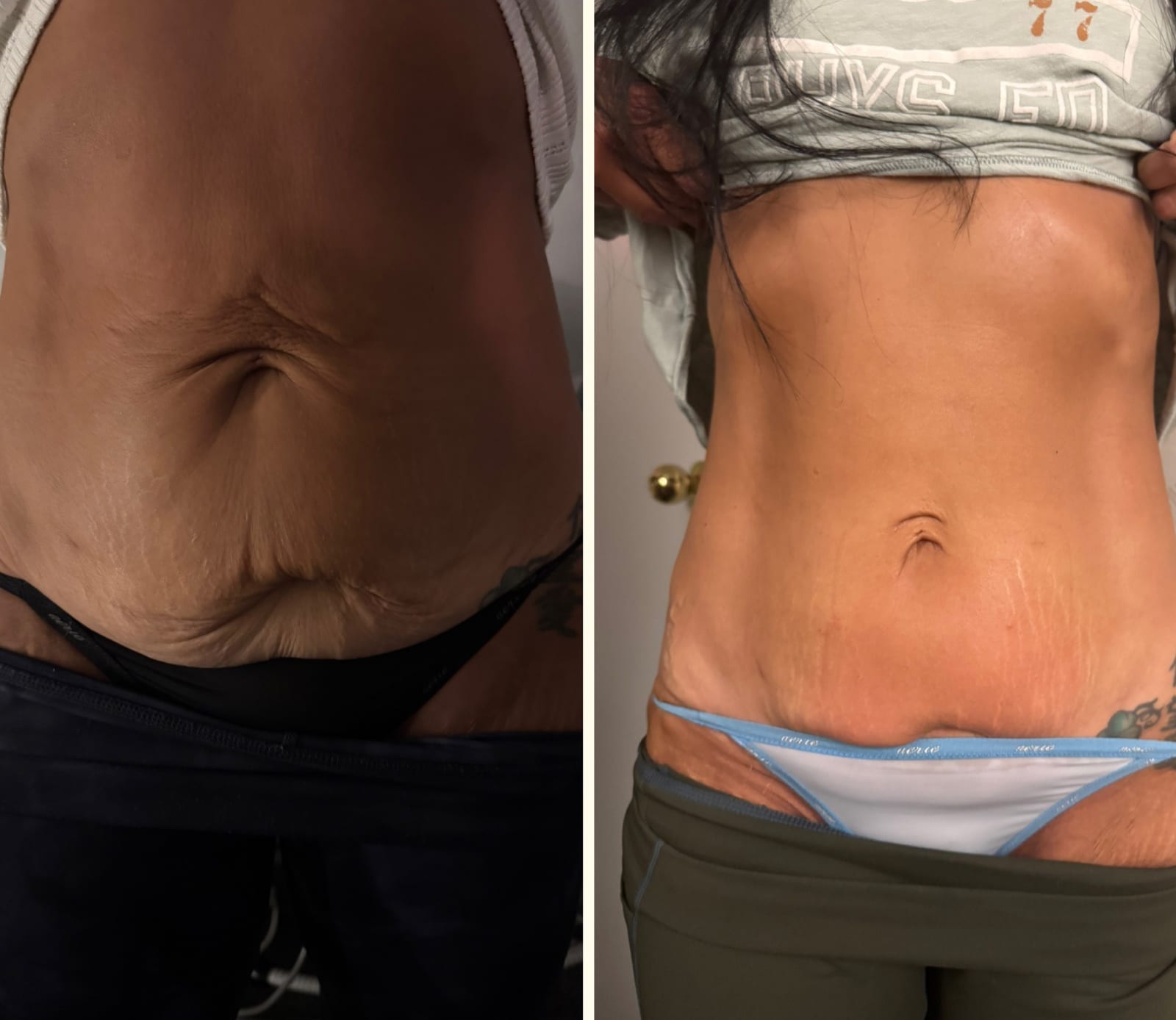 Body sculpting result 6 of 8, a real before and after from a Bossa treatment series.
