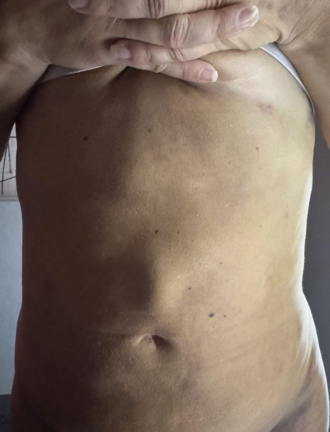 Body sculpting result 7 of 8, a collage of real Bossa before and after photographs.