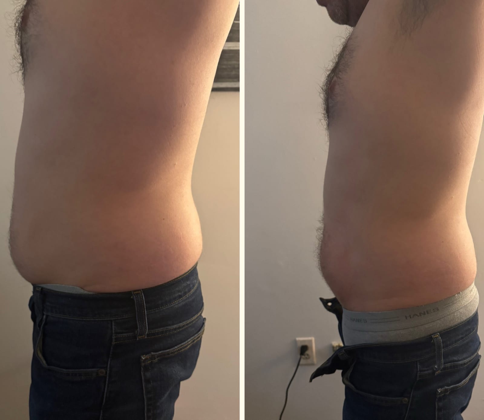 Body sculpting result 3 of 8, a real before and after from a Bossa treatment series.