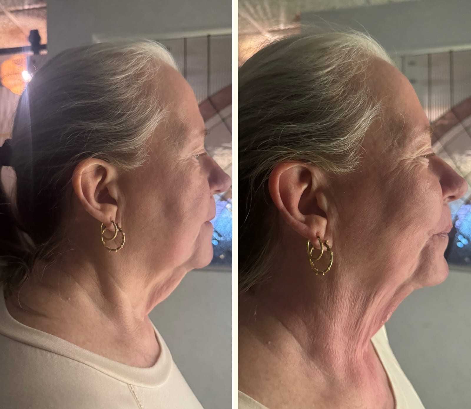 Body sculpting result 5 of 8, a real before and after from a Bossa treatment series.