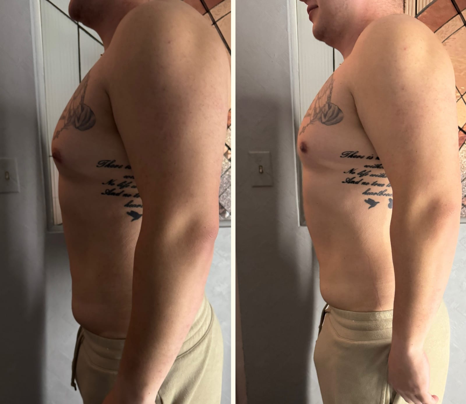 Body sculpting result 4 of 8, a real before and after from a Bossa treatment series.