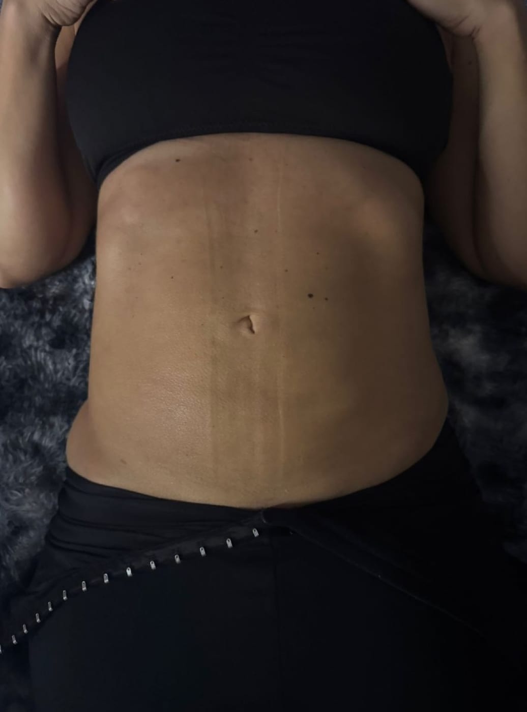 Body sculpting result 8 of 8, a collage of real Bossa before and after photographs.