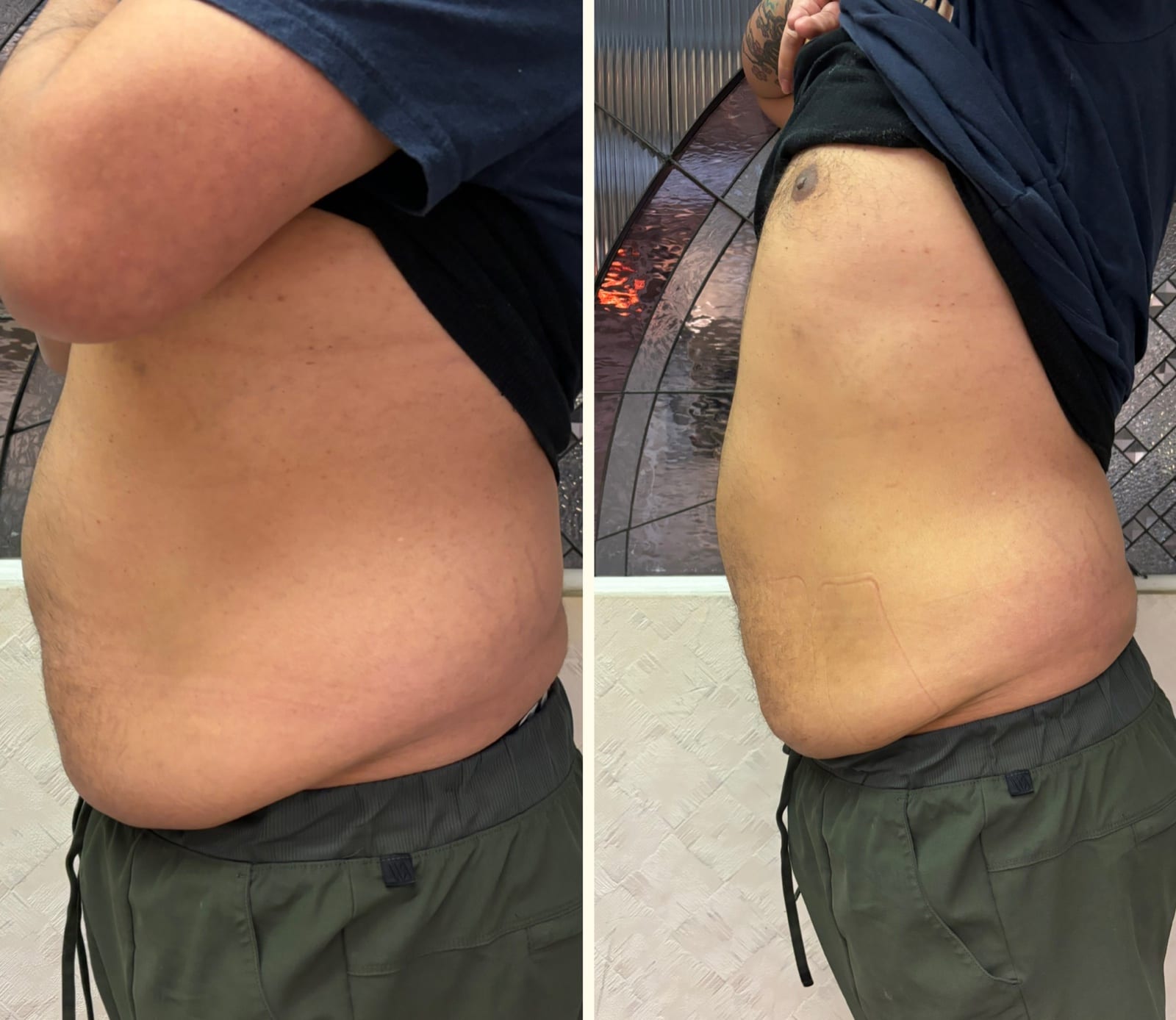 Body sculpting result 2 of 8, a real before and after from a Bossa treatment series.